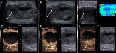 Malignant glomus tumor of the breast: a case report